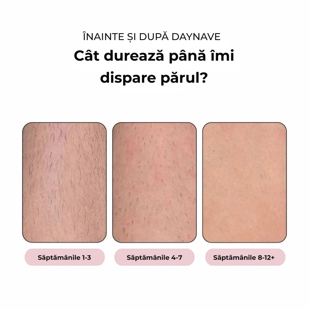 Daynava™ Epilator IPL (RO)